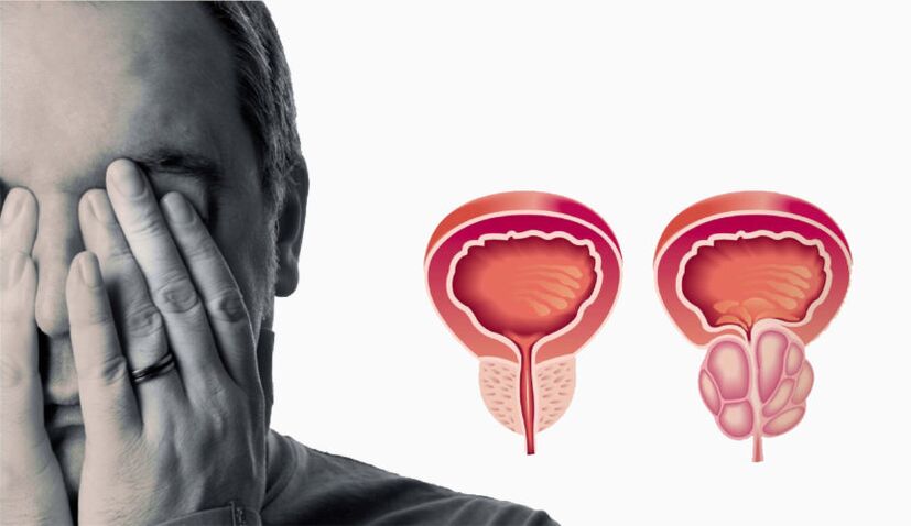 Chronic prostatitis