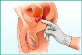 Prostate palpation