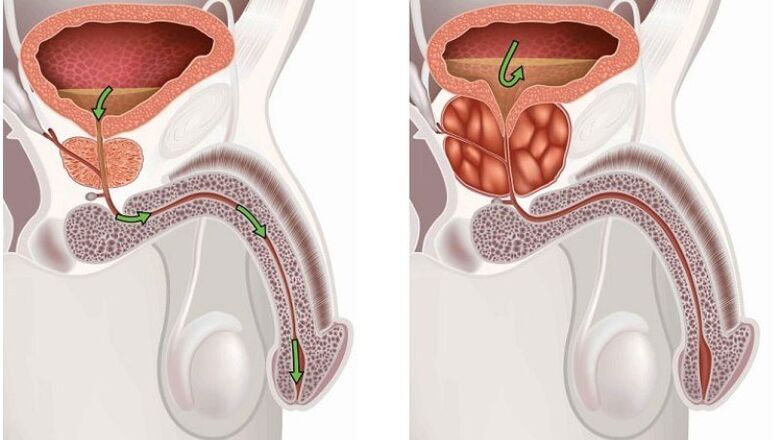 Healthy and inflamed prostate gland with prostatitis.