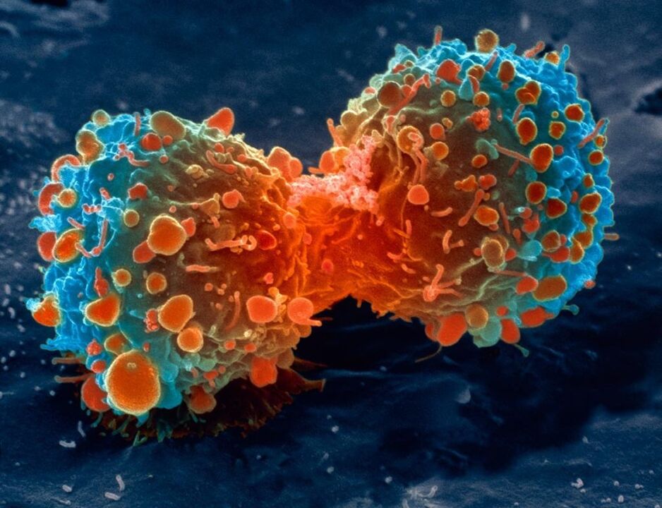 Tumor cell as a complication of prostatitis.